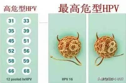 疣状表皮发育不良:女子打过hpv疫苗，6年后却查出宫颈癌，疫苗不管用吗，为何？