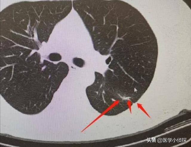 养生堂代茶饮方治疗肺部结节,肺结节喝什么水好能散结？