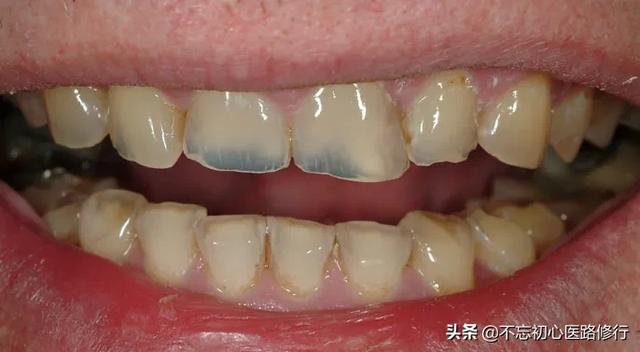 轻度四环素牙是什么颜色:四环素牙涂什么颜色的口红 什么是牙齿美白，什么样的牙齿适合美白？