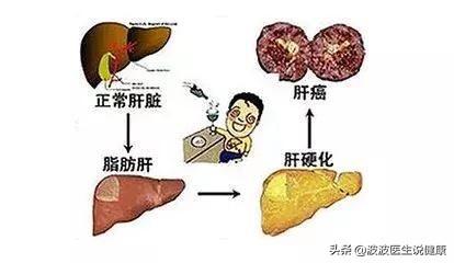 肝硬化是什么引起的图片