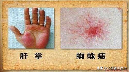 肝癌来临是否有“预示”？
