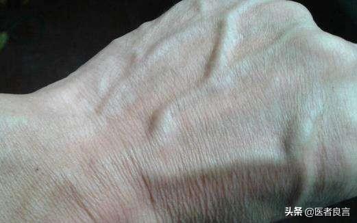 头条问答 - 肝癌变,手先知,是真的吗?是什么原理?(25个回答)