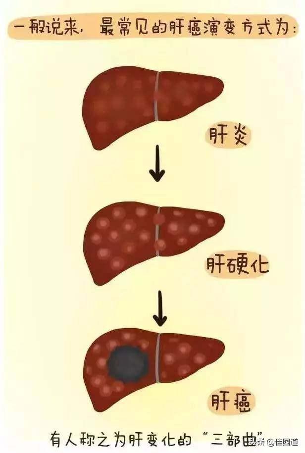 狗狗黑色素瘤早期症状图片:有人说肝癌早期身体会发出3大信号，是指什么？还能挽救吗？