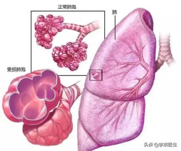 慢阻肺发展到最后是呼吸衰竭吗?是否有办法避免呢? - 我的小天地