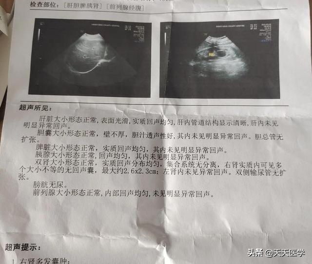 只有一个肾有囊肿要处理吗:左肾囊肿是什么问题，医院开了消炎药和止痛药，请问这能根治吗？