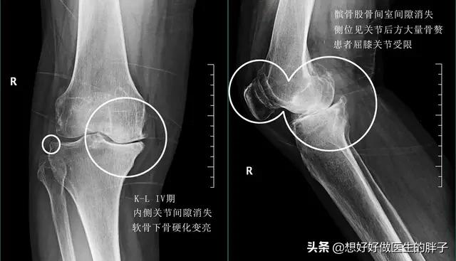 骨软骨病x线特征:骨软骨瘤x线表现是什么 骨癌的X线检查有什么表现？