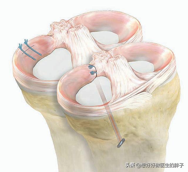 半月板损伤症状:半月板损伤症状有哪些 膝盖半月板损伤还能治好吗？