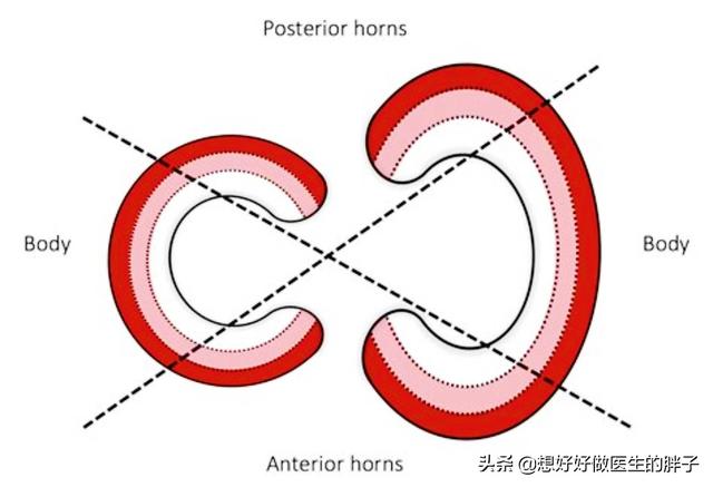 半月板损伤症状:半月板损伤是严重的病吗？