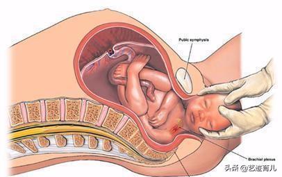 肩难产:肩难产视频教学 什么是巨大儿？巨大儿有哪些危害？