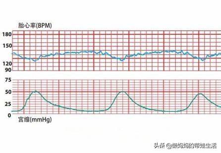 怀孕34周胎心监护过高,胎动不明显幅度不大,吃了巧克力还是不动怎么办？