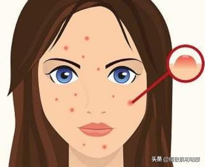 脸上的暗疮怎么去除，脸上长痤疮怎么排毒祛痘？