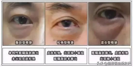 眼袋该怎么办(突然发现有眼袋了怎么办)