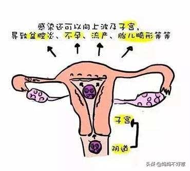 孕妇阴道炎症该怎么办:孕期的时候就是出现了霉菌性炎症，影不影响顺产？