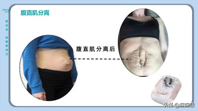 什么是腹直肌分离