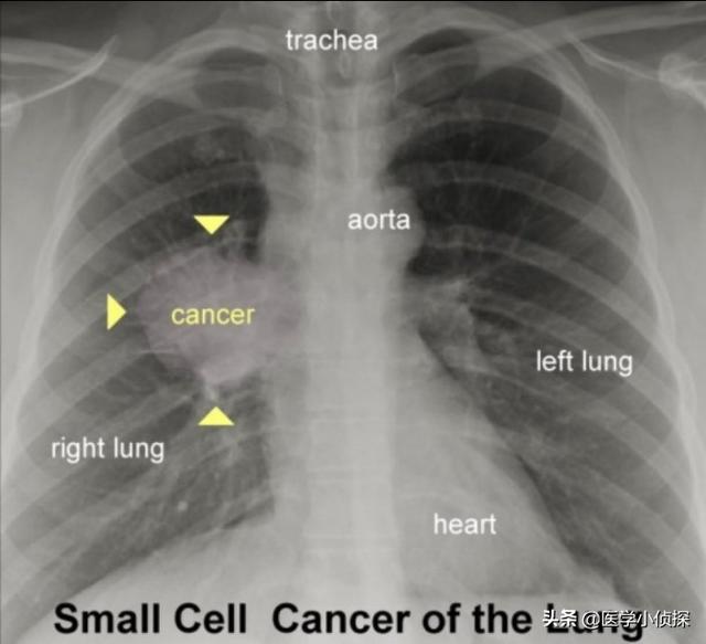 头条问答 肺癌都是悄无声息地发生吗 手指头的症状能说明是肺癌吗 41个回答