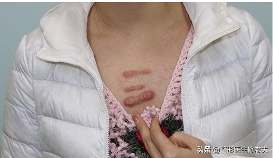 疤痕性体质(疤痕性体质是什么原因导致的)