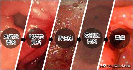 头条问答 - 胃糜烂会不会发展成胃癌?(25个回答)