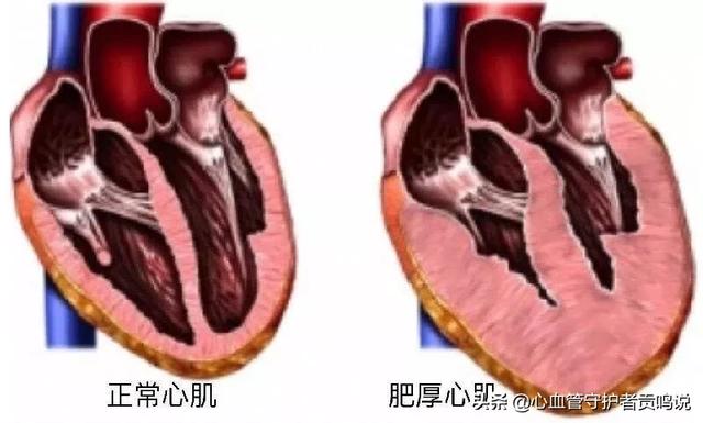 肥厚型心肌病心超分型:肥厚型心肌病，该如何控制血压？