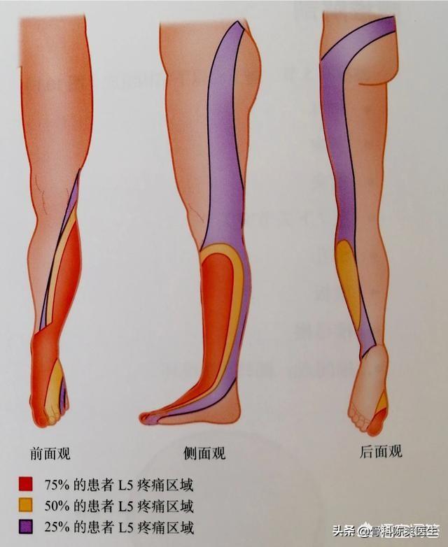 常见脊柱病:哪些病可以引起脊柱源性神经痛？