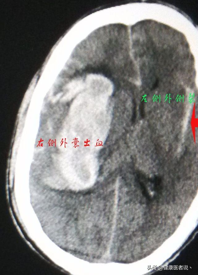 左侧外囊区脑出血是严重的位置吗