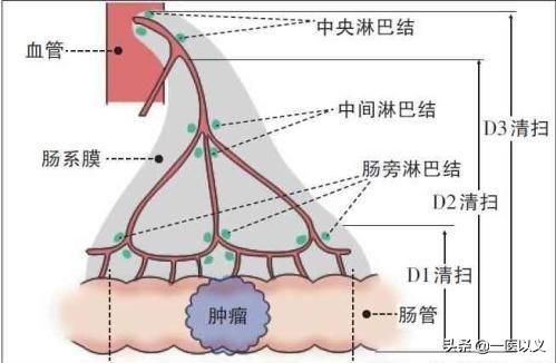 预防肠道疾病教学设计:幼儿园预防肠道疾病教案 引起肠癌的原因有哪些？肠癌能预防吗？