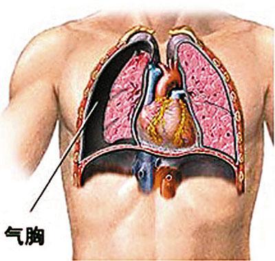 头条问答 肺大泡的症状有哪些 应该如何治疗 27个回答