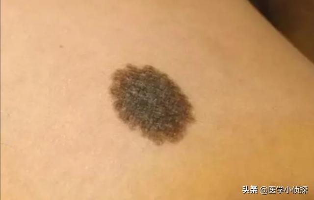 7莱姆病症状太容易被忽视:哪些症状连续出现是癌症的表现？