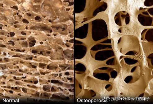 手指头风湿关节炎如何缓解，得了风湿性关节炎的人应该如何护理？