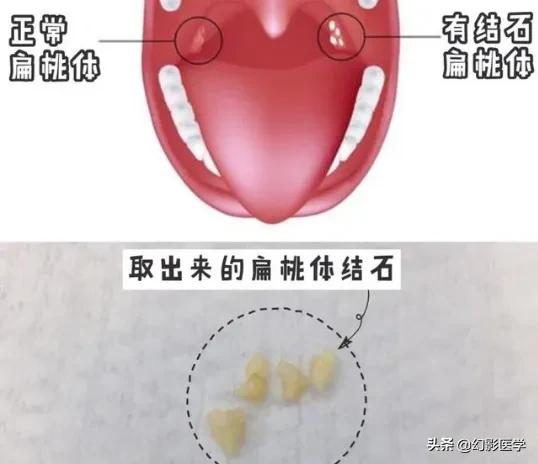 头条问答 扁桃体结石能用棉签挤出来吗 130个回答