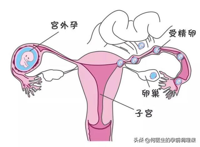 导致宫外孕的原因有哪些，造成宫外孕的原因是什么切除输卵管之后对身体有什么伤害