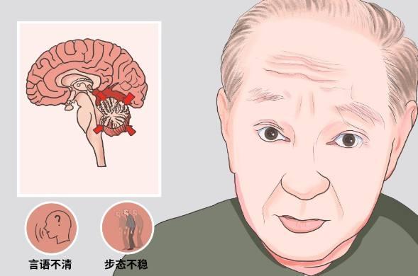 小腦萎縮是怎麼引起的_老人輕度腦白質病變伴腦萎縮