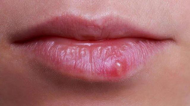 头条问答 - 嘴唇为什么会起泡?是上火了吗?(24个回答)