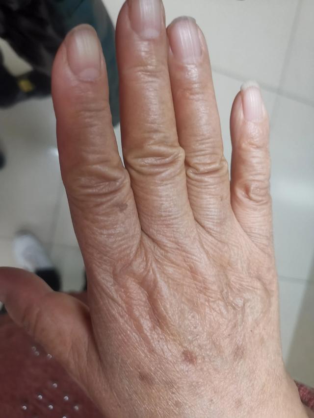 请问你们什么时候发现手上开始长老年斑的