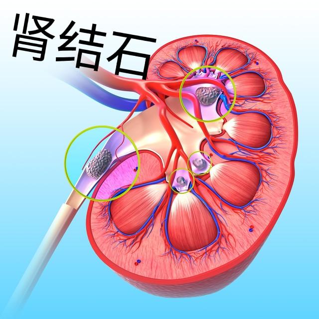 尿结石的治疗方法:尿结石能不能排出来呢？有哪些排出来的方法呢？