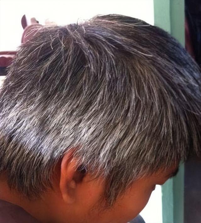 熬夜和精神紧张长出来的白头发还能变黑回来吗