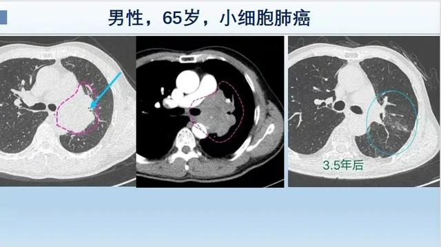 癌症从一开始就已经决定一个人的命运，治和不治都一样，是真的吗？插图3