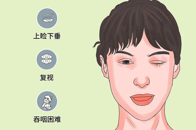 重症肌无力都分什么类型