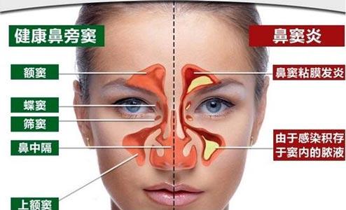 头条问答 - 鼻窦炎的症状及表现?(11个回答)