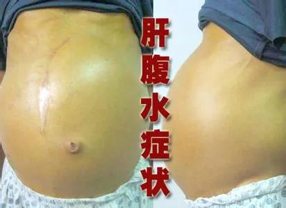 四,黄疸:肝癌晚期,肝内或肝门肿瘤压迫或肝细胞广泛性坏死,造成阻塞性
