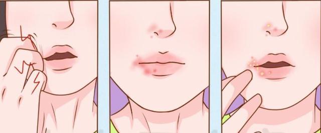 嘴唇上起泡是什么原因引起的受惊吓嘴唇起泡是什么原因