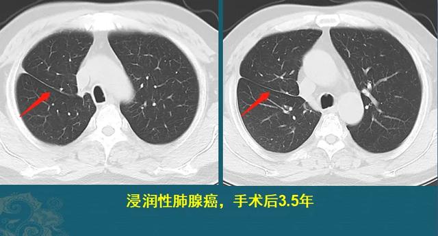 癌症从一开始就已经决定一个人的命运，治和不治都一样，是真的吗？插图2
