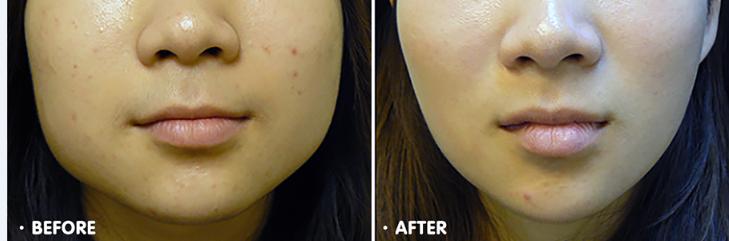 吃槟榔,腮帮子咬肌都练起来了,把脸型都嚼变形了,要怎么样才能恢复?