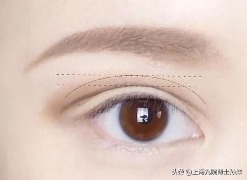双眼皮内眼角拆线多少钱:做完切开双眼皮＋开内眼角拆线后有必要搽一些抗疤痕的药吗？