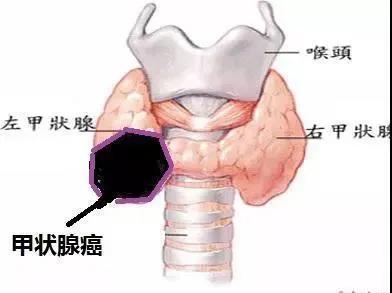 不影响寿命的十大癌症:现如今哪些癌症能被临床治愈，或者5年存活率高？