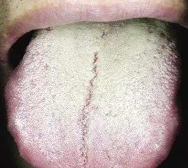 舌头胖大有齿痕，需要怎么调理？插图9