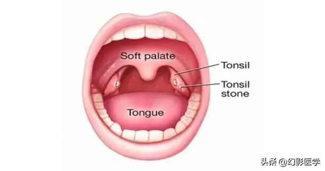 头条问答 扁桃体结石能用棉签挤出来吗 130个回答