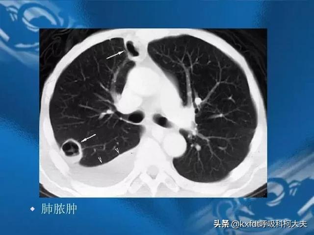 肺部真菌感染:常年肺部感染、吐黄痰、抗菌素效果不佳到底该不该切肺？