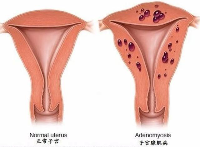 子宮腺肌症是什麼病嚴重嗎痛經很嚴重的人是因為子宮腺肌症嗎為什麼