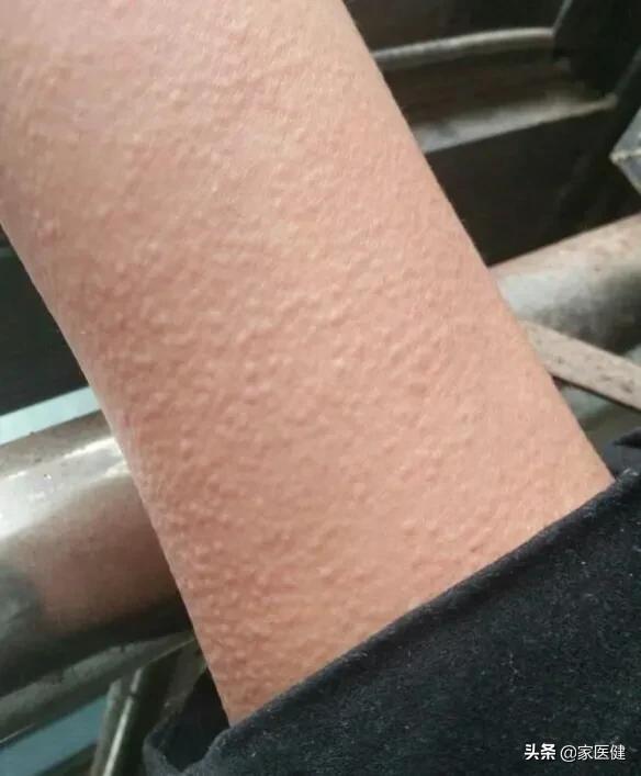 得了胆碱能性荨麻疹是一种什么感觉