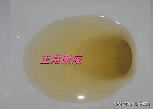 糖尿病泡沫尿为什么时有时无